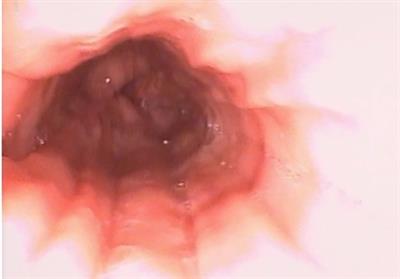 Duodenal stenosis, an unusual presentation of eosinophilic gastroenteritis: a case report